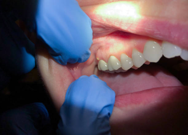 Best Emergency Root Canal Treatment in Wickes, AR